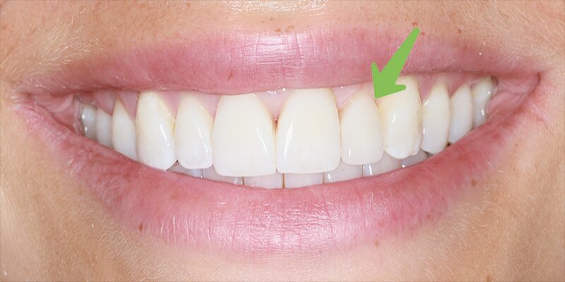 Close-up of a smile with a green arrow pointing to a chipped front tooth.