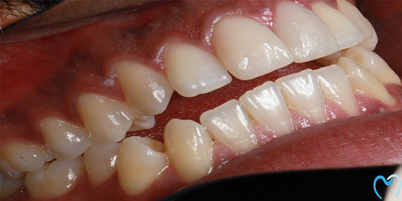 Close-up of human teeth showing dental misalignment.