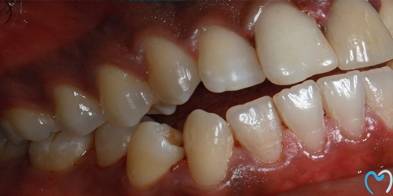 Close-up of teeth showing dental issues like cavities and gum inflammation.