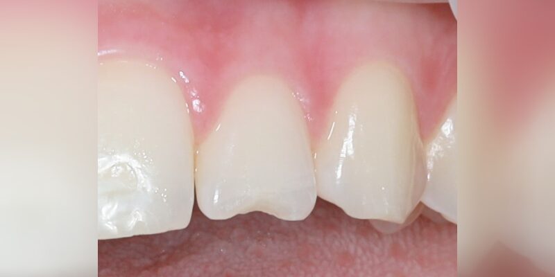 Chipped incisor next to intact teeth