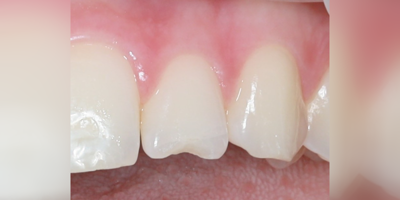 Close-up of chipped front tooth among healthy teeth.