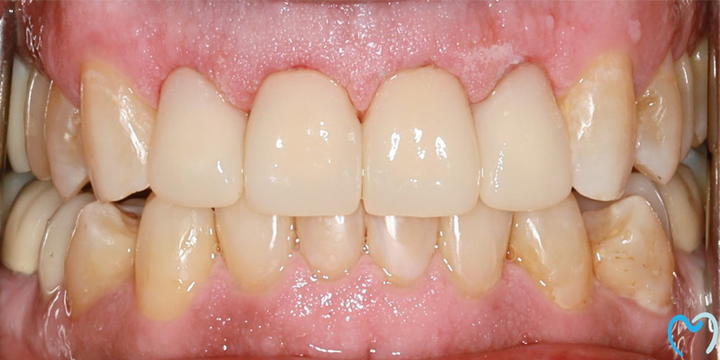 Close-up of upper and lower teeth showing dental crowns.