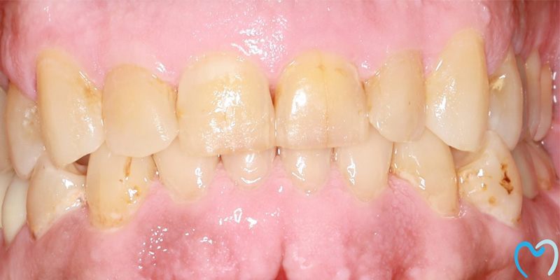 Close-up of stained and plaque-covered front teeth with visible gum inflammation.