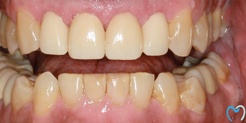 Close-up of upper dental crowns and lower natural teeth showing wear.