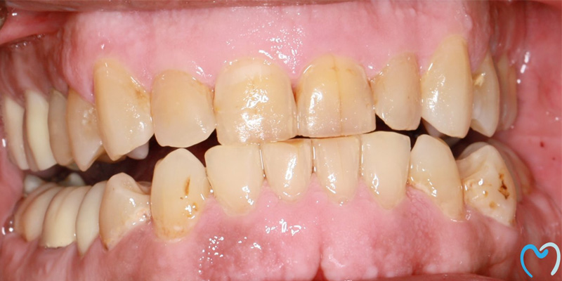 Close-up of teeth with visible plaque and discoloration.