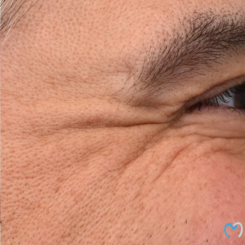 Close-up of skin wrinkles around a squinting eye.