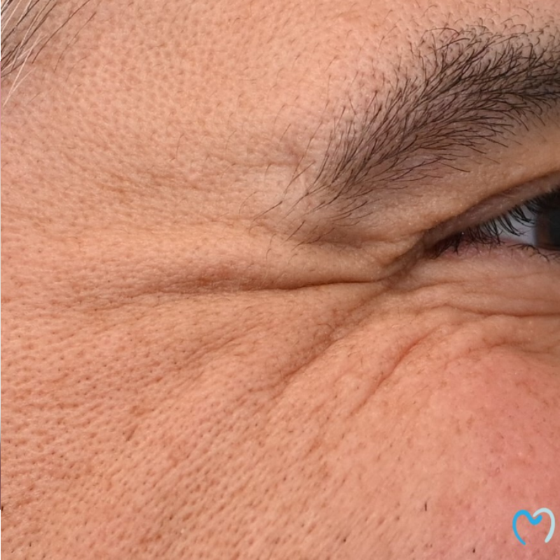 Close-up of skin wrinkles around a squinting eye.