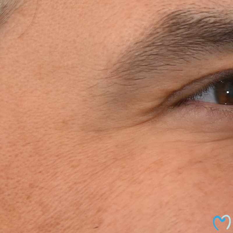 Close-up of a person's eye and eyebrow with visible skin texture.