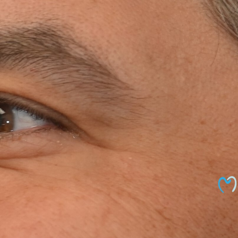 Close-up of a person's eye and surrounding skin.