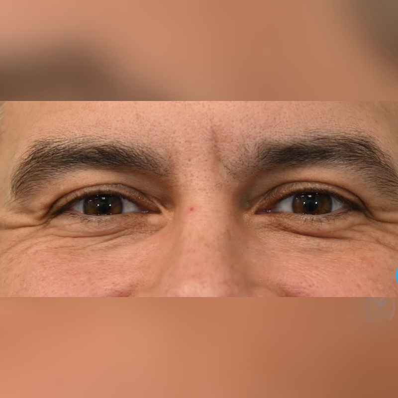Close-up of a person's eyes with visible wrinkles and natural skin texture.