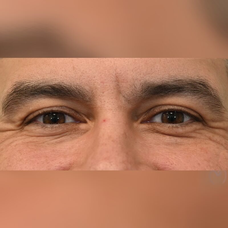 Close-up of a person's eyes and upper nose area.