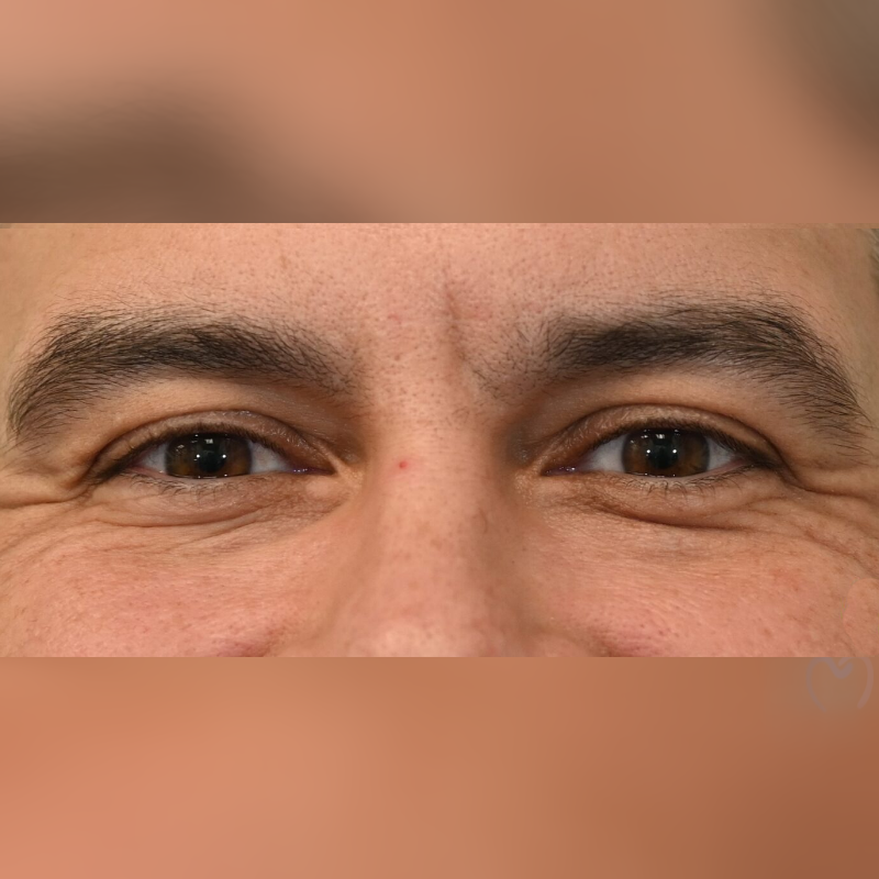 Close-up of a person's eyes and upper nose area.