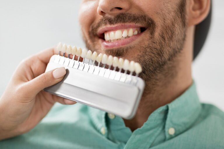 Replacing Veneers: What to Expect and Why